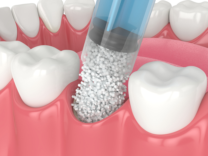 3D render of bone grafting for dental implants.