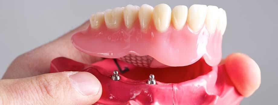 3 Distinct Benefits Of All On 4 Dental Implants Implant And Perio