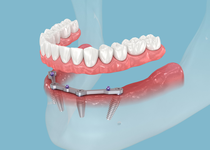 Mandibular prosthesis with gum All on 4 system supported by dental implants.