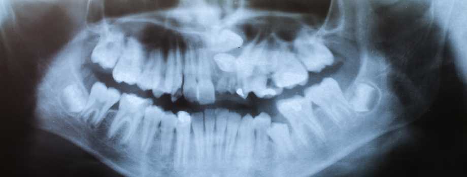 Jaw Deformity