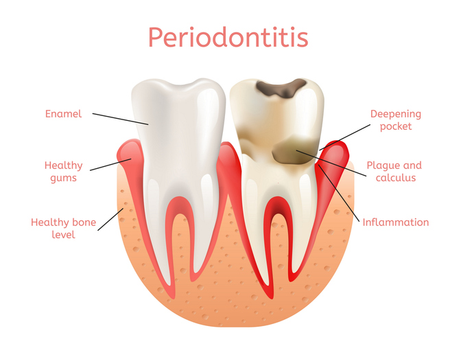 Periodontitis, Inflammation of Gums