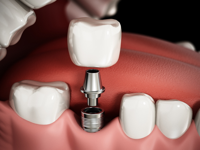 3D rendering representing the structure of dental implant procedure.