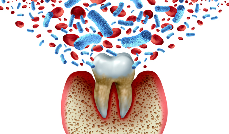 Tooth decay, blood, and bacteria on unhealthy molar with periodontitis due to poor oral hygiene.