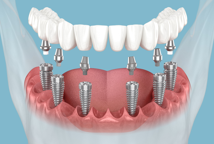 3D illustration of human teeth and mandibular prosthesis with All on 6 dental implants.
