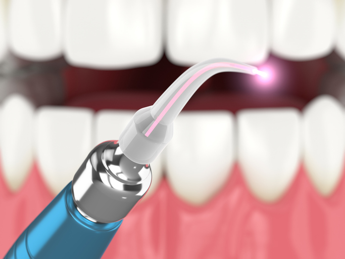 3d render of dental diode laser used to treat gums. The concept of using laser therapy in the treatment of gums.